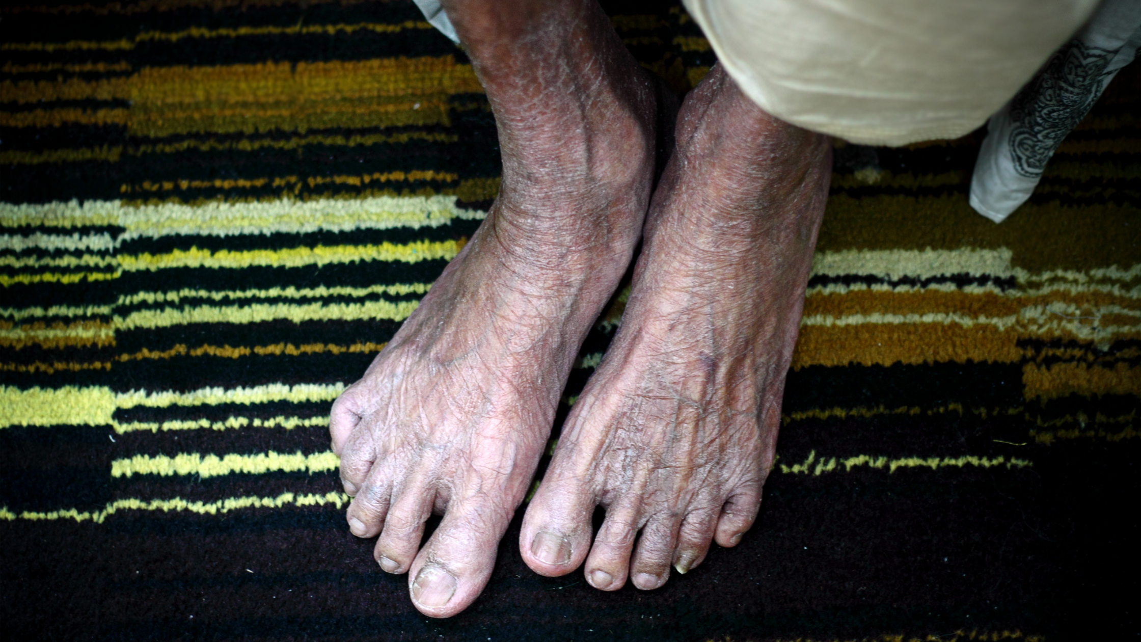 Common Foot Ailments for the Elderly